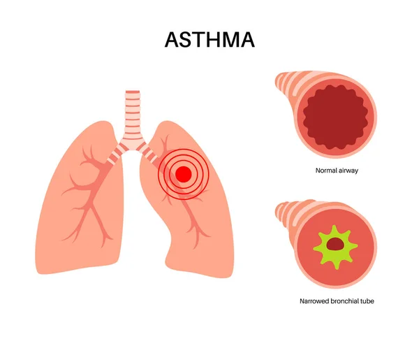 Concept Maladie Asthme Essoufflement Oppression Thoracique Causes Toux Voies Respiratoires — Image vectorielle