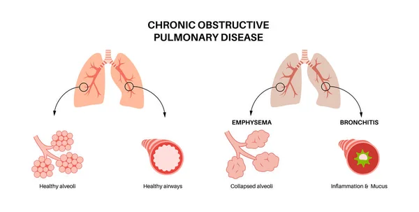Maladie Pulmonaire Obstructive Chronique Mpoc Groupe Maladies Pulmonaires Problème Avec — Image vectorielle