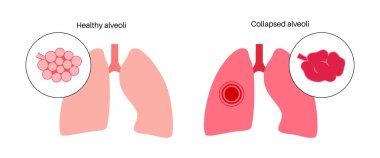 Amfizem hastalığı konsepti. Hasarlı alveoller, solunum yolu arızası. İnsan ciğerlerindeki hava keselerinin arasındaki sarkık duvarlar. Nefes darlığı, göğüs sıkışması. Solunum sistemi düz vektör illüstrasyonunun rahatsızlığı