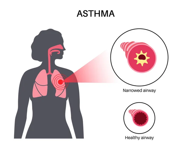 Koncepcja Choroby Astmy Krótki Oddech Ucisk Klatce Piersiowej Przyczyny Kaszlu — Wektor stockowy
