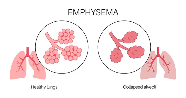 Emphysema Disease Concept 肺泡受损 气道失败 人肺气囊之间的软墙 呼吸急促 呼吸道系统疾病平面病媒说明 — 图库矢量图片