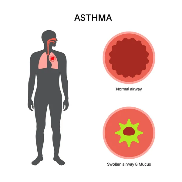 Astma Sykdomskonsept Kortpustethet Tetthet Brystet Årsaker Til Hoste Smale  Fine – stockvektor ©Pikovit 648440356