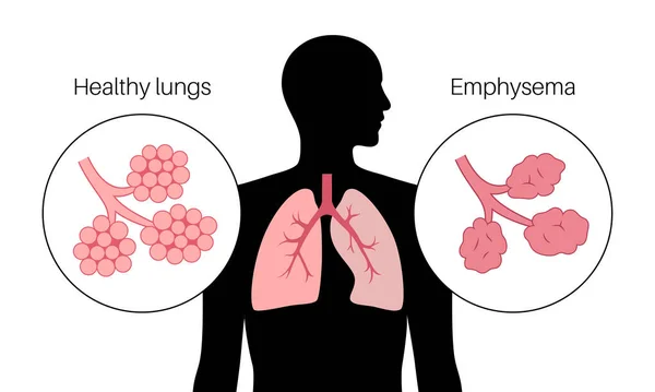 肺気腫の概念 損傷した肺胞 失敗した気道 人間の肺の中の空気袋の間の浮遊壁 息切れ 胸の圧迫感 呼吸器系フラットベクトル図の病気 — ストックベクタ