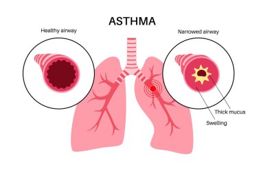 Astım hastalığı konsepti. Nefes darlığı, göğüs darlığı, öksürük. Dar ve şişkin hava yolları, akciğerlerde ekstra mukus. Alerjik durum, solunum sistemi vektör çizimi sorunu