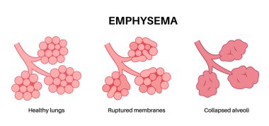 Amfizem hastalığı konsepti. Hasarlı alveoller, solunum yolu arızası. İnsan ciğerlerindeki hava keselerinin arasındaki sarkık duvarlar. Nefes darlığı, göğüs sıkışması. Solunum sistemi düz vektör illüstrasyonunun rahatsızlığı