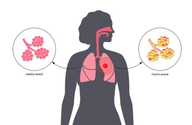 Zatürree enfeksiyonu anatomik poster. İnsan solunum sisteminde iltihap. Sıvı alveollü. Ciğerlerde hastalık, göğüste irin maddesi. Zor nefes alma ve öksürük vektörü çizimi