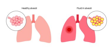 Zatürree enfeksiyonu anatomik poster. İnsan solunum sisteminde iltihap. Sıvı alveollü. Ciğerlerde hastalık, göğüste irin maddesi. Zor nefes alma ve öksürük vektörü çizimi