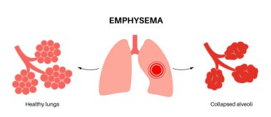 Amfizem hastalığı konsepti. Hasarlı alveoller, solunum yolu arızası. İnsan ciğerlerindeki hava keselerinin arasındaki sarkık duvarlar. Nefes darlığı, göğüs sıkışması. Solunum sistemi düz vektör illüstrasyonunun rahatsızlığı