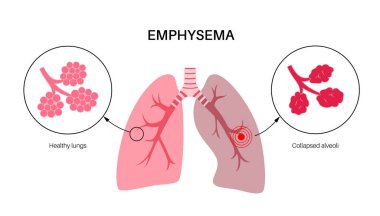 Amfizem hastalığı konsepti. Hasarlı alveoller, solunum yolu arızası. İnsan ciğerlerindeki hava keselerinin arasındaki sarkık duvarlar. Nefes darlığı, göğüs sıkışması. Solunum sistemi düz vektör illüstrasyonunun rahatsızlığı