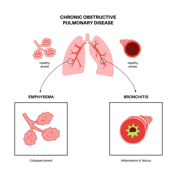 Maladie Pulmonaire Obstructive Chronique Mpoc Groupe Maladies Pulmonaires Problème Avec — Image vectorielle