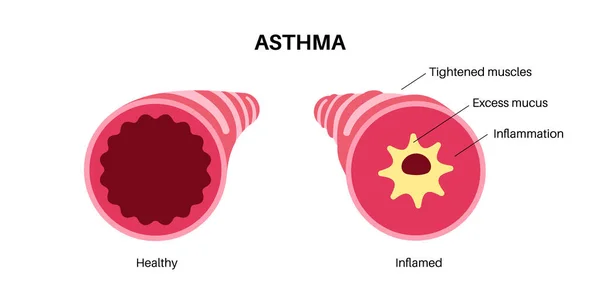 哮喘的概念 呼吸急促胸闷咳嗽的原因狭窄而肿胀的气管 肺里多余的粘液 过敏性状况 呼吸系统病媒说明问题 — 图库矢量图片