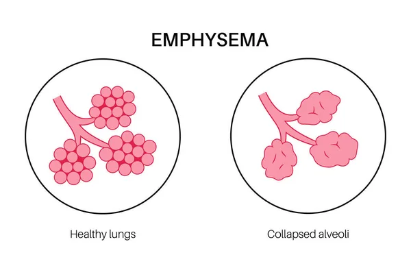 stock vector Emphysema disease concept. Damaged alveoli, failure airway. Floppy walls between air sacs in human lungs. Shortness of breath, chest tightness. Illness of respiratory system flat vector illustration