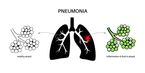 Pneumoni Infektion Anatomisk Affisch Inflammation Människans Andningsorgan Alveoli Med Vätska — Stock vektor