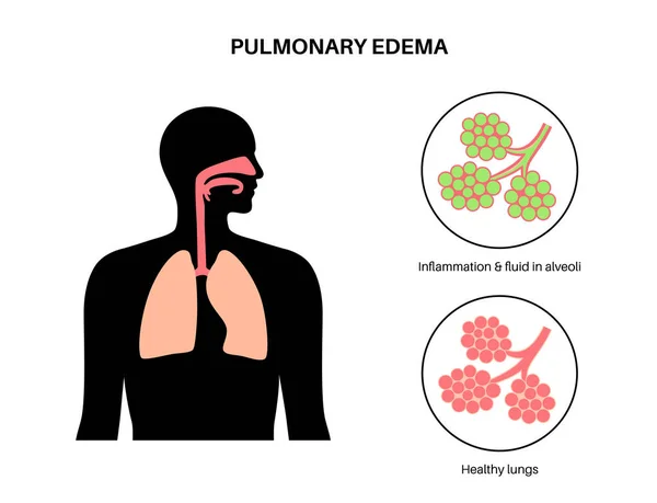 肺水肿解剖海报 肺里有不正常的液体人类呼吸系统的炎症 肺泡有液体 胸部的紫色物质 呼吸急促和咳嗽原因 — 图库矢量图片