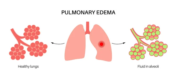 폐부종 해부학 포스터 폐속의 비정상적 인간의 호흡계 에서의 액체로 가슴에 — 스톡 벡터