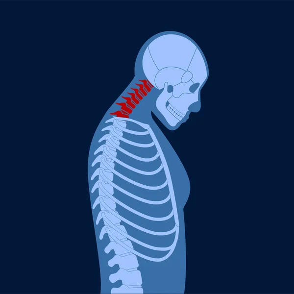 Diagramm Der Deformation Der Halswirbel Nackenkrämpfe Schmerzen Der Wirbelsäule Steifheit — Stockvektor