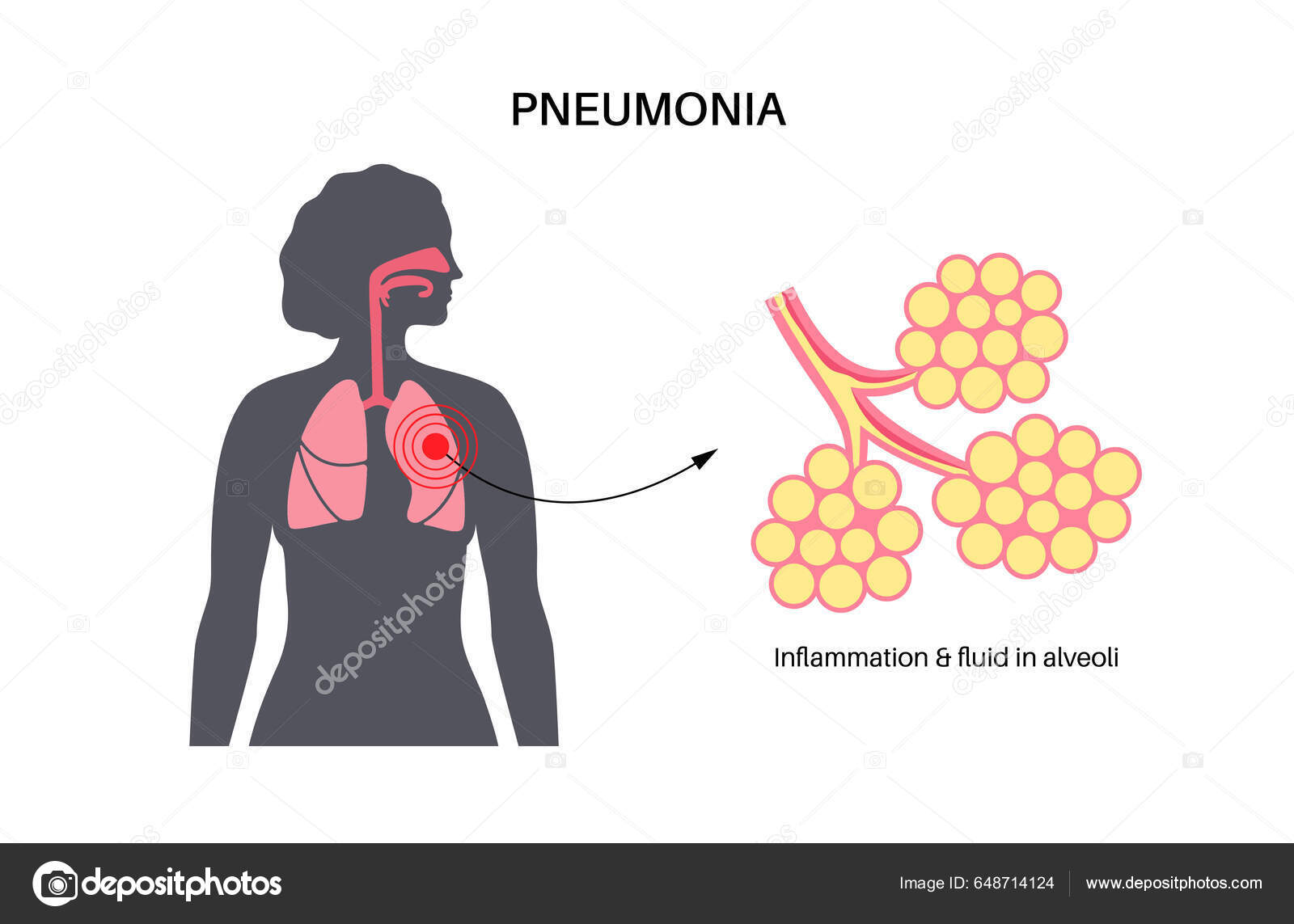 Pneumonia Infection Anatomical Poster Inflammation Human Respiratory ...