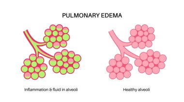 Pulmoner ödem anatomik poster. Akciğerlerinde anormal sıvı var. İnsan solunum sisteminde iltihap. Sıvı alveollü. Göğüste iltihaplı madde. Nefes darlığı ve öksürük nedenleri