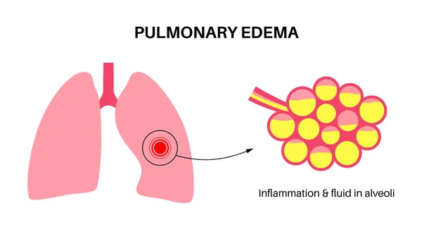 Pulmoner Ödem Anatomik Poster Akciğerlerinde Anormal Sıvı Var Nsan Solunum — Stok Vektör