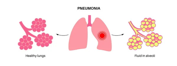 Infección Por Neumonía Póster Anatómico Inflamación Sistema Respiratorio Humano Alvéolos — Vector de stock