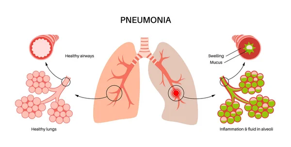 Інфекція Пневмонії Анатомічний Плакат Запалення Дихальній Системі Людини Альвеолі Рідиною — стоковий вектор