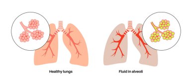 Zatürree enfeksiyonu anatomik poster. İnsan solunum sisteminde iltihap. Sıvı alveollü. Ciğerlerde hastalık, göğüste irin maddesi. Zor nefes alma ve öksürük vektörü çizimi