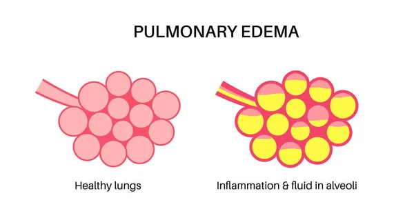 Affiche Anatomique Sur Oedème Pulmonaire Liquide Anormal Dans Les Poumons — Image vectorielle