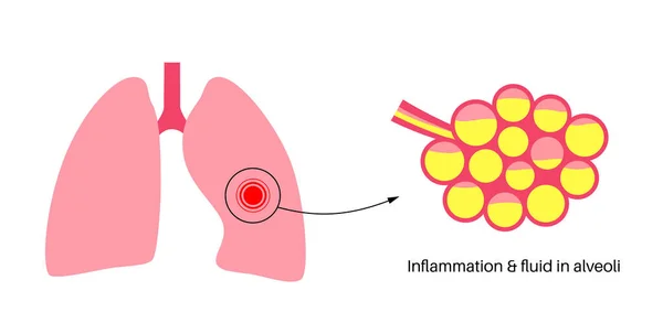 肺炎感染解剖海报 人类呼吸系统的炎症 肺泡有液体 肺部疾病 胸部有化脓性物质 呼吸困难和咳嗽病媒说明 — 图库矢量图片