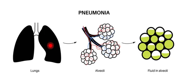 Pneumoni Infektion Anatomisk Affisch Inflammation Människans Andningsorgan Alveoli Med Vätska — Stock vektor