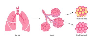Zatürree enfeksiyonu anatomik poster. İnsan solunum sisteminde iltihap. Sıvı alveollü. Ciğerlerde hastalık, göğüste irin maddesi. Zor nefes alma ve öksürük vektörü çizimi