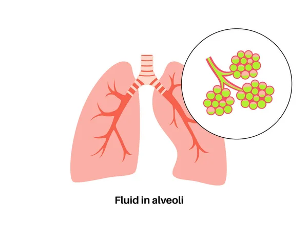 Infección Por Neumonía Póster Anatómico Inflamación Sistema Respiratorio Humano Alvéolos — Vector de stock
