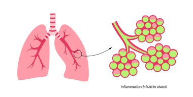 Zatürree enfeksiyonu anatomik poster. İnsan solunum sisteminde iltihap. Sıvı alveollü. Ciğerlerde hastalık, göğüste irin maddesi. Zor nefes alma ve öksürük vektörü çizimi