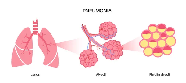 Affiche Anatomique Sur Infection Pneumonique Inflammation Système Respiratoire Humain Alvéoles — Image vectorielle