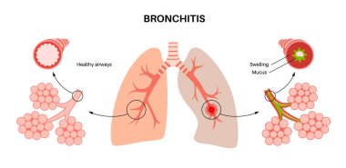Bronşit kavramı, akciğer enfeksiyonu. Bronşik anatomik poster. Sinirli, şişmiş ve iltihaplı solunum yolları. Nefes darlığı, öksürük, göğüs ağrısı ve akciğerlerde mukus düz vektör çizimi.
