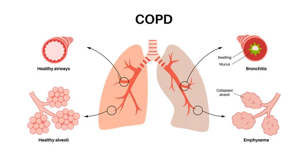 Chronisch Obstruktive Lungenerkrankung Oder Copd Gruppe Von Lungenkrankheiten Probleme Mit — Stockvektor