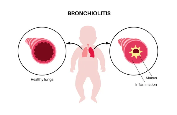 Infección Por Bronquiolitis Cuerpo Del Niño Pequeño Infección Viral Los — Vector de stock