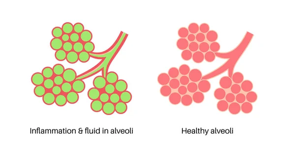 Zatürree Enfeksiyonu Anatomik Poster Nsan Solunum Sisteminde Iltihap Sıvı Alveollü — Stok Vektör
