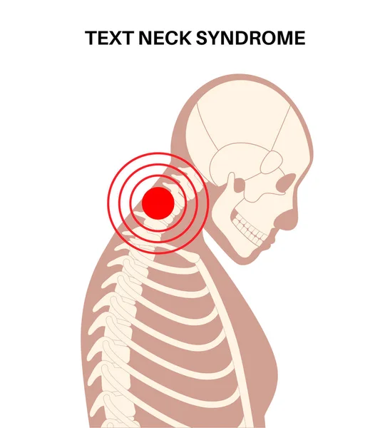 子宮頸椎の変形図 首痙攣 脊椎の痛み 肩の剛性と圧迫感 男性の体の健康的な背骨とこぶ医療ベクトル図 骨格シルエット — ストックベクタ