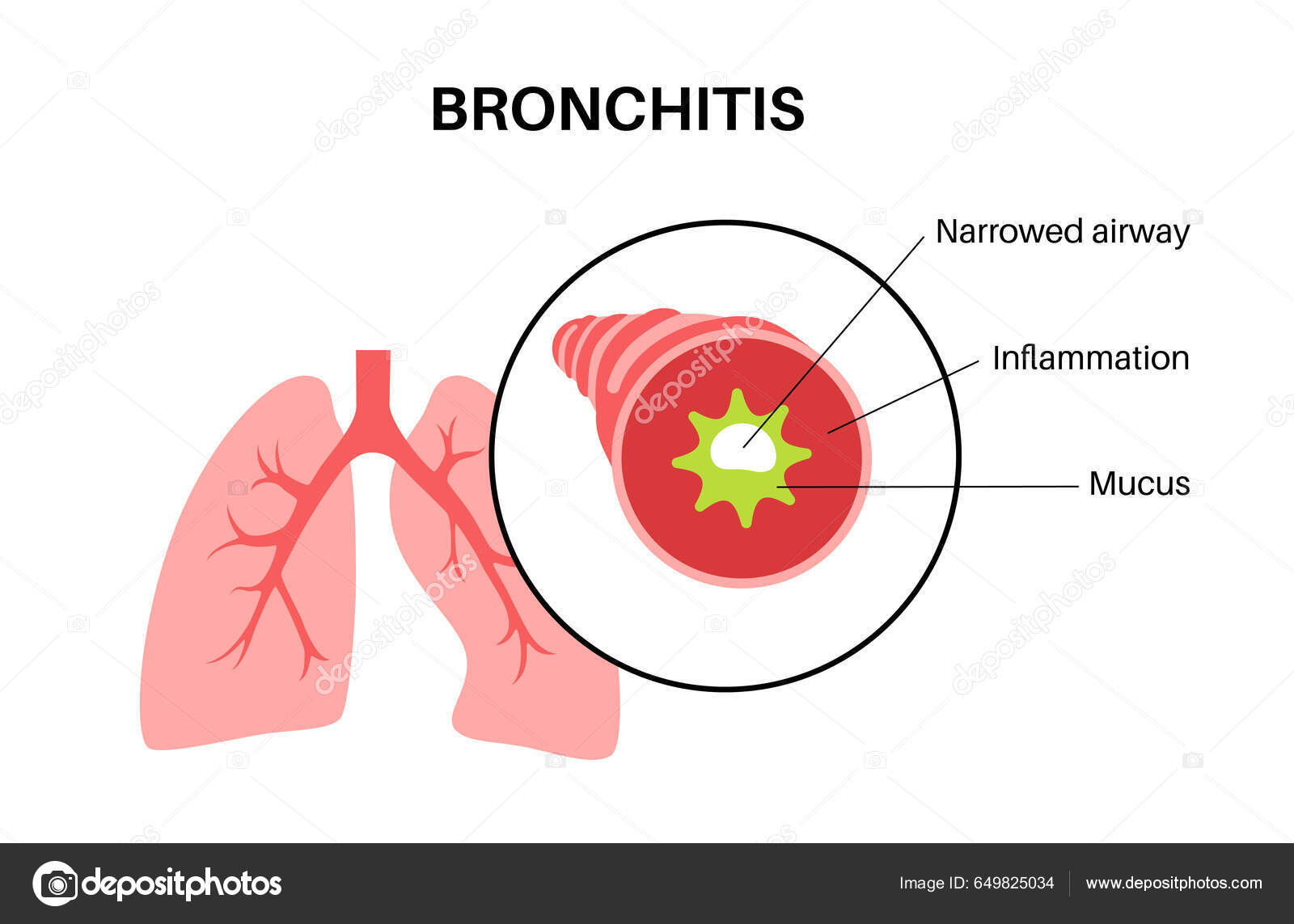 Bronchitis Lungenentzündung Bronchi Anatomisches Plakat Gereizte  Geschwollene Und Entzündete Atemwege Stock-Vektorgrafik von ©Pikovit  649825034