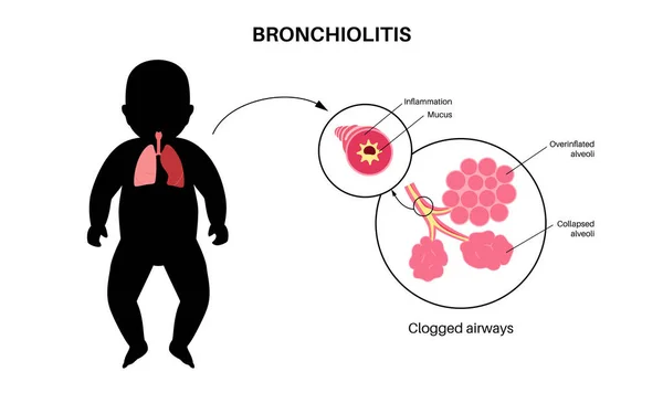Genç Bedende Bronşit Enfeksiyonu Bebek Siluetinde Viral Akciğer Enfeksiyonu Solunum — Stok Vektör