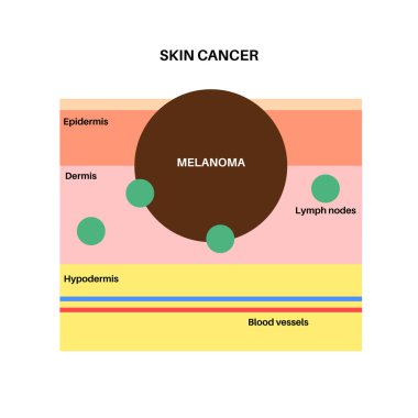 Melanoma grafik posteri, cilt kanseri gelişimi bilgileri. Derinin derinliklerinde, üst deriden deriye ve diğer iç organlara kadar kötü huylu tümör büyümüş. Dermatoloji incelemesi düz vektör