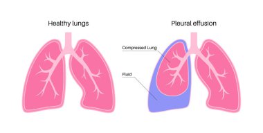 Pleural effusion disease. Fluid between the layers of tissue in lungs and chest cavity. DIfficult breathing. Unhealthy internal organs in the human body. Respiratory system medical vector illustration clipart