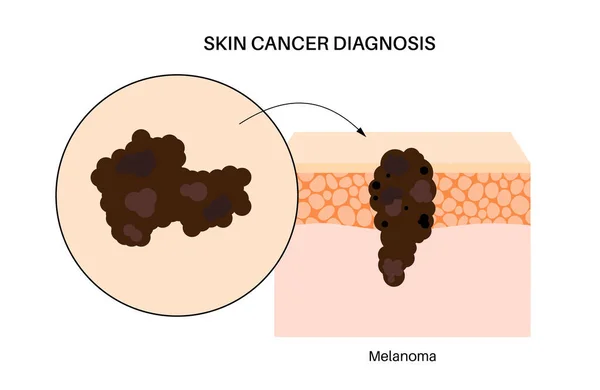 黑色素瘤解剖海报皮肤癌发展恶性肿瘤从表皮到其他内脏器官的皮肤层不断增长 皮肤科临床扁平载体的诊断与治疗 — 图库矢量图片