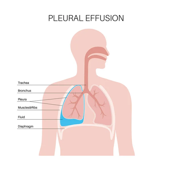 Pleural Effusion Disease Cairan Antara Lapisan Jaringan Paru Paru Dan - Stok Vektor