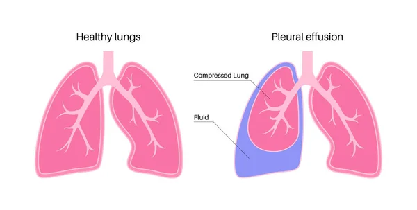 Pleural Effusion Disease Fluid Layers Tissue Lungs Chest Cavity Difficult — Stock Vector