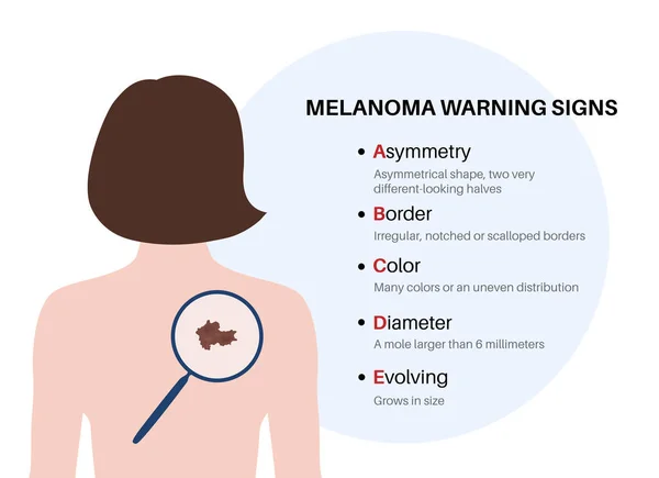 stock vector Melanoma warning signs. ABCDE rule for skin cancer. Asymmetrical shape, irregular border, many colors, big diameter, evolving size of mole. Oncology prevention medical poster flat vector illustration.