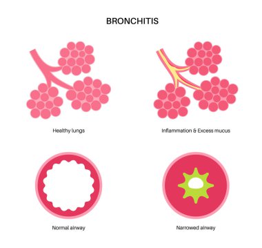 Bronşit kavramı, akciğer enfeksiyonu. Bronşik anatomik poster. Sinirli, şişmiş ve iltihaplı solunum yolları. Nefes darlığı, öksürük, göğüs ağrısı ve akciğerlerde mukus düz vektör çizimi.