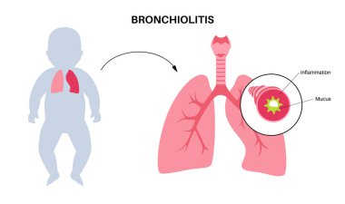 Genç bedende bronşit enfeksiyonu. Bebek siluetinde viral akciğer enfeksiyonu. Solunum yollarında iltihap ve mukus var. Akciğer hastalığı, göğüs ağrısı ve öksürük yassı vektör çizimi..