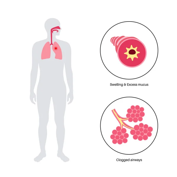 Bronşit Kavramı Akciğer Enfeksiyonu Bronşik Anatomik Poster Sinirli Şişmiş Iltihaplı — Stok Vektör