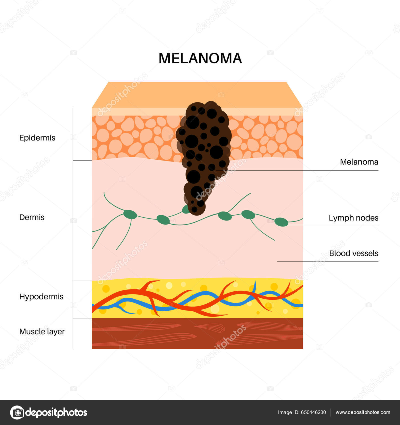 Μελάνωμα Ανατομική Αφίσα Ανάπτυξη Καρκίνου Του Δέρματος Κακοήθης Ανάπτυξη  Όγκου Διανυσματικό Αρχείο από ©Pikovit650446230